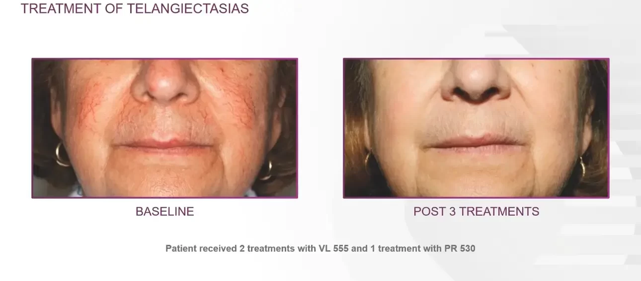Telaniectasias | before and after | Advanced Care & Medspa | Lisle, IL