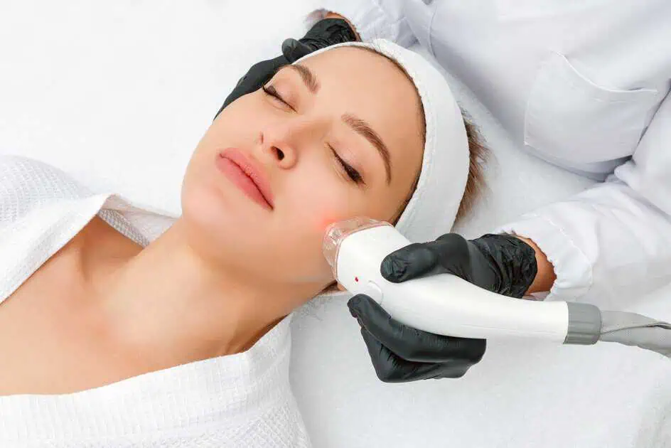 Rosacea laser treatment at Advanced Care & Med Spa to prevent flare-ups and reduce redness